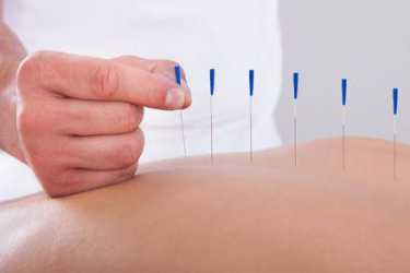Akupunktura Doktora Kima 60min